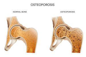 Homecare Huntington Beach CA - What You Should Know About Osteoporosis